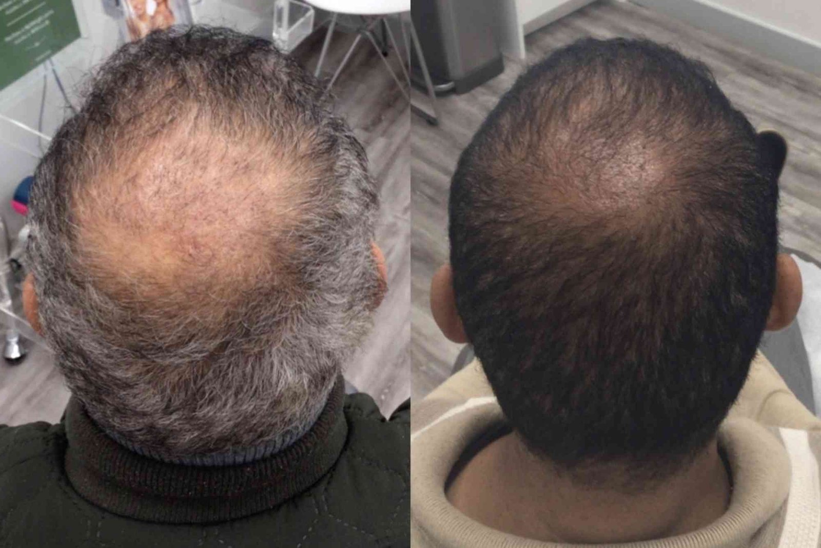 Best Hair Transplat Turkey